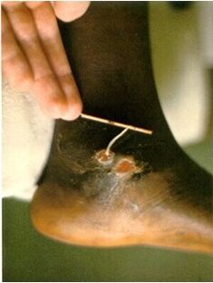 Guinea worm extracted from the leg of a person suffering from dracunculiasis