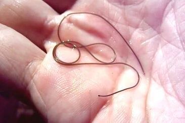 parasitic worm from the human body